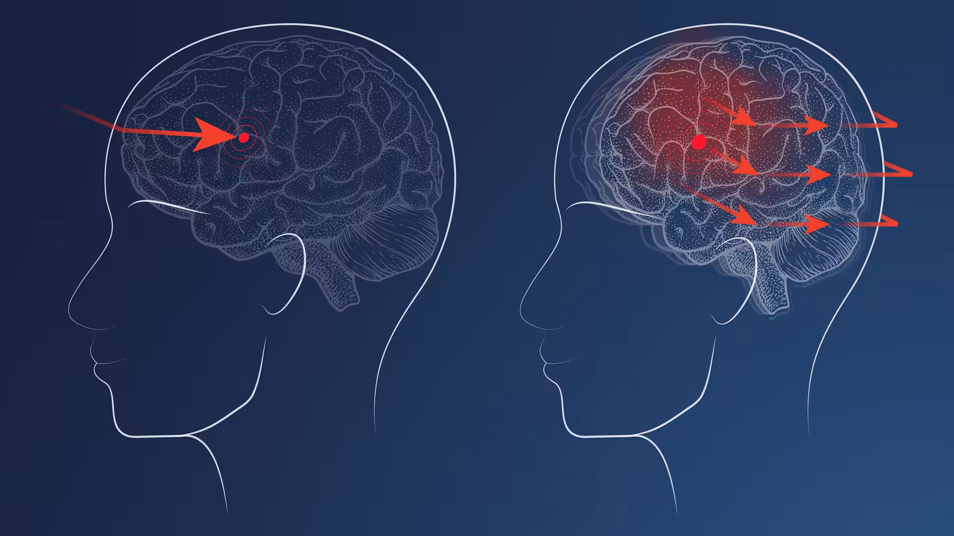 head-impact-diagram Head impact diagram
