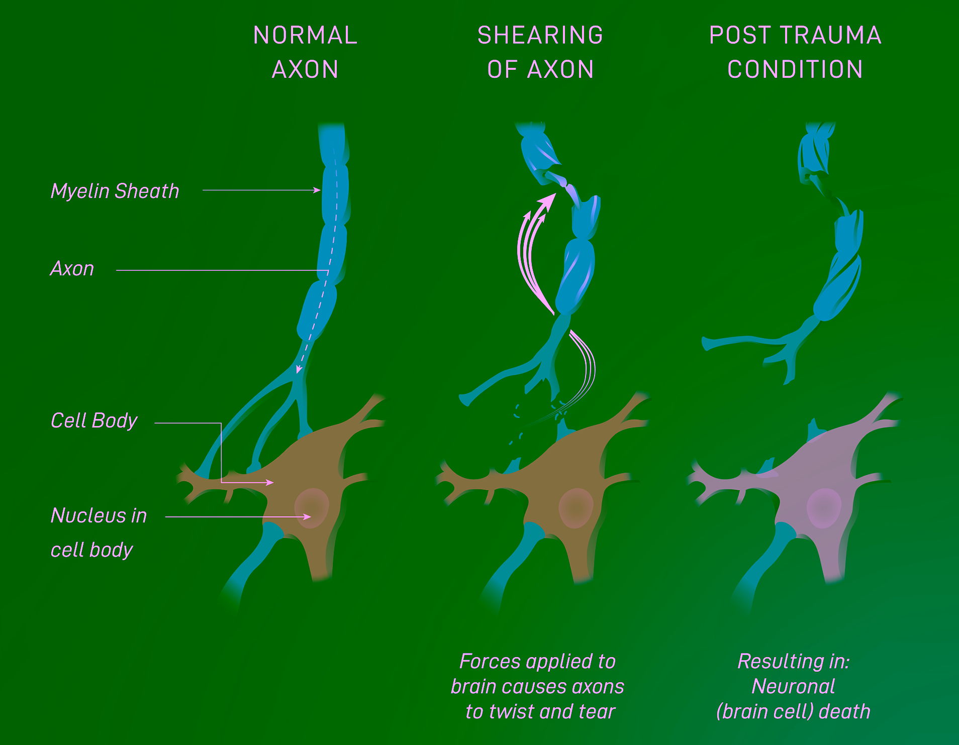 Rotational brain cell damage diagram