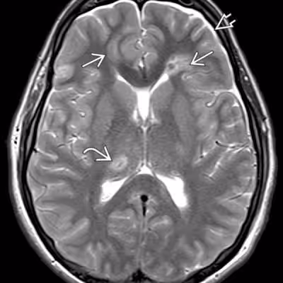 Brain microhaemorrhages