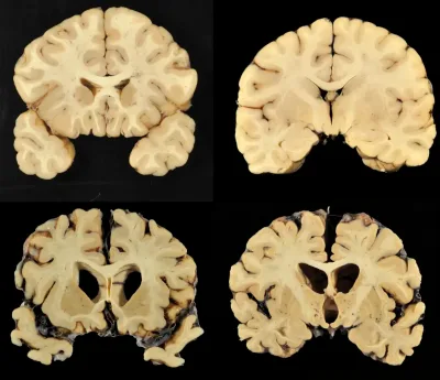 An image showing the difference between a normal brain and a CTE brain.